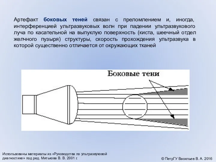 Артефакт боковых теней связан с преломлением и, иногда, интерференцией ультразвуковых волн