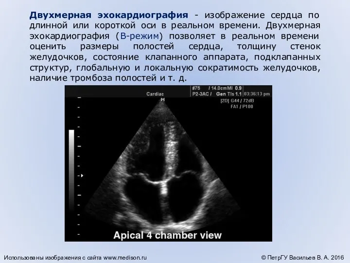 Двухмерная эхокардиография - изображение сердца по длинной или короткой оси в