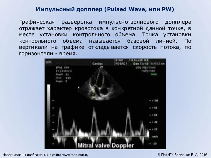 Импульсный допплер (Pulsed Wave, или PW) Графическая разверстка импульсно-волнового допплера отражает