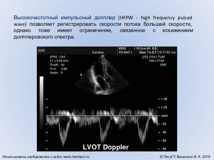 Высокочастотный импульсный допплер (HFPW - high frequency pulsed wave) позволяет регистрировать