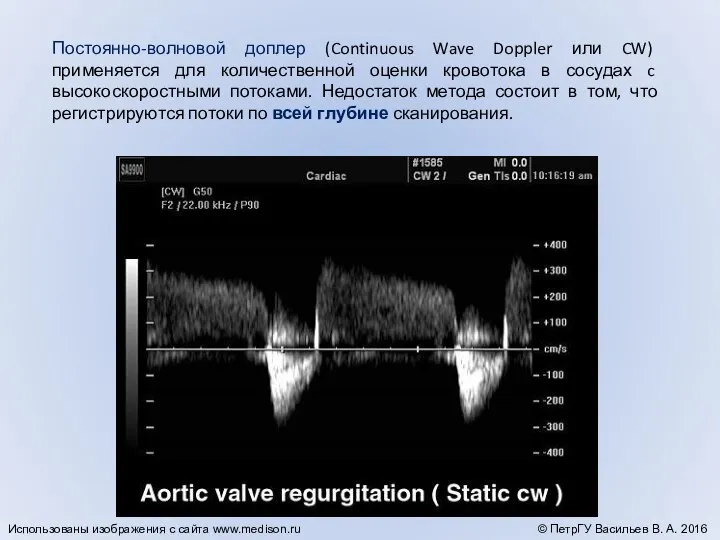 Постоянно-волновой доплер (Continuous Wave Doppler или CW) применяется для количественной оценки