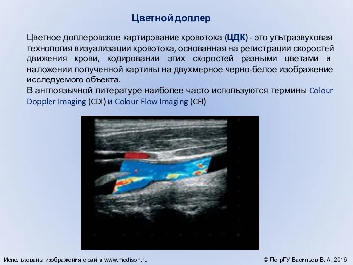 Цветное доплеровское картирование кровотока (ЦДК) - это ультразвуковая технология визуализации кровотока,