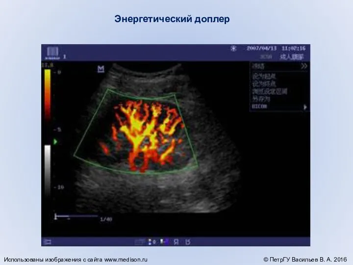 Энергетический доплер © ПетрГУ Васильев В. А. 2016 Использованы изображения с сайта www.medison.ru