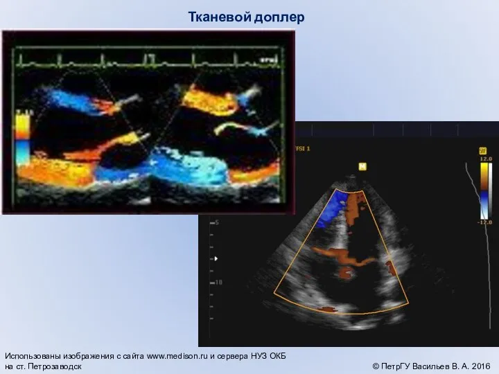 Тканевой доплер © ПетрГУ Васильев В. А. 2016 Использованы изображения с