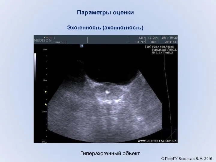 Параметры оценки Гиперэхогенный объект Эхогенность (эхоплотность) © ПетрГУ Васильев В. А. 2016