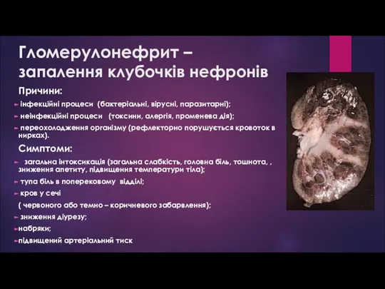 Гломерулонефрит – запалення клубочків нефронів Причини: інфекційні процеси (бактеріальні, вірусні, паразитарні);