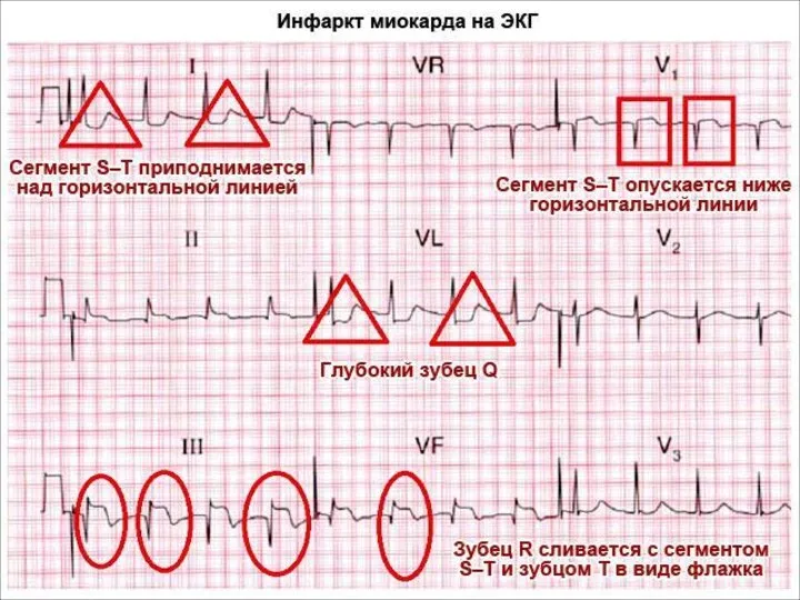 ЭКГ при инфаркте миокарда