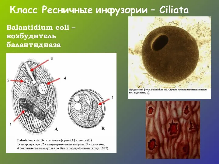 Balantidium coli – возбудитель балантидиаза Класс Ресничные инфузории – Ciliata