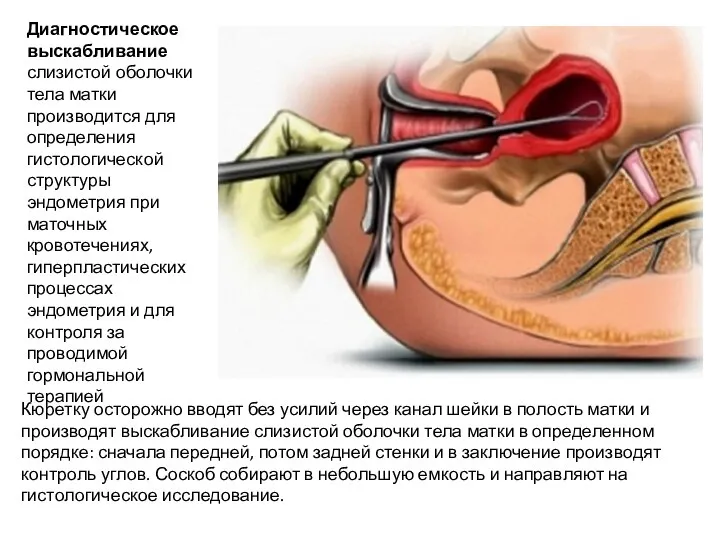 Диагностическое выскабливание слизистой оболочки тела матки производится для определения гистологической структуры