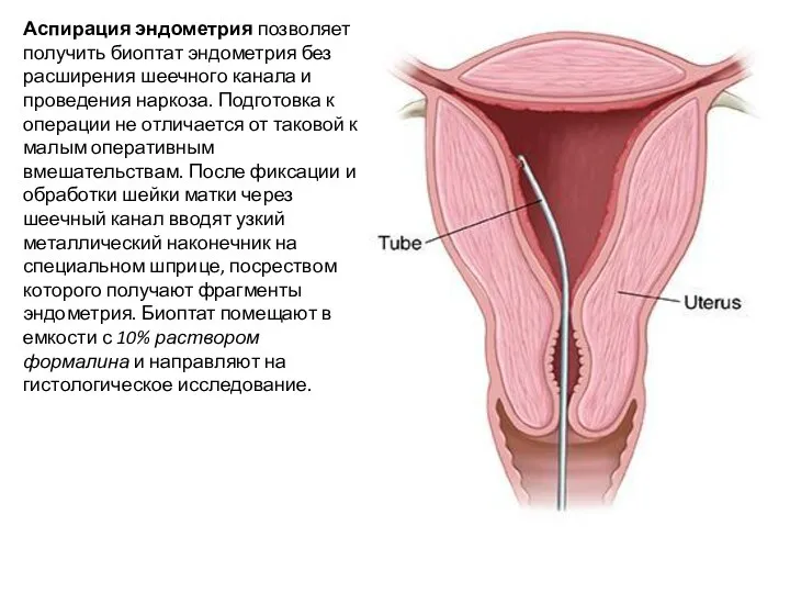 Аспирация эндометрия позволяет получить биоптат эндометрия без расширения шеечного канала и