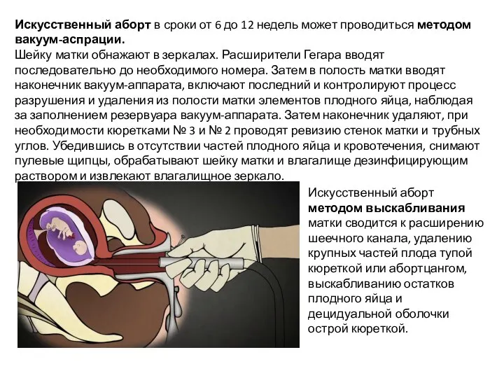 Искусственный аборт в сроки от 6 до 12 недель может проводиться