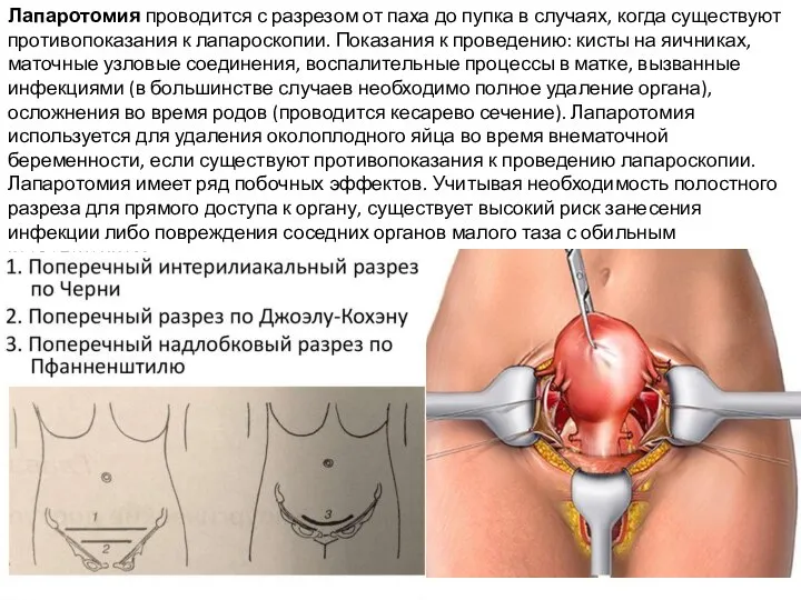 Лапаротомия проводится с разрезом от паха до пупка в случаях, когда