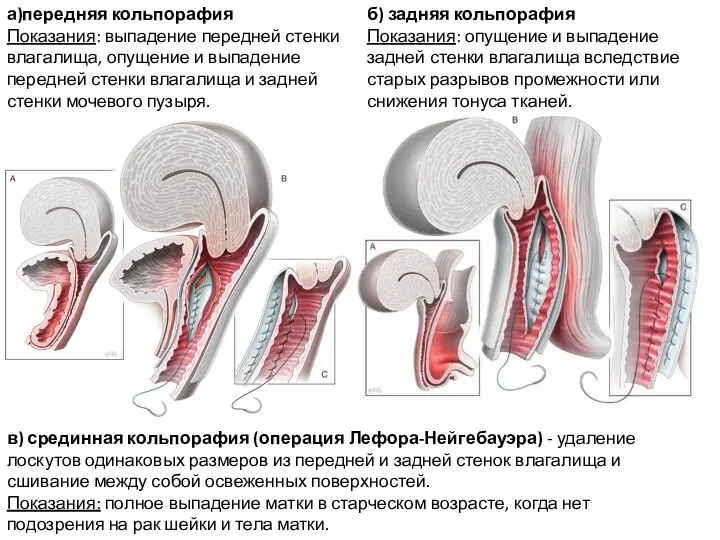 а)передняя кольпорафия Показания: выпадение передней стенки влагалища, опущение и выпадение передней