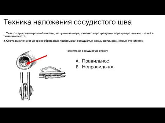 Техника наложения сосудистого шва 1. Участок артерии широко обнажают доступом непосредственно