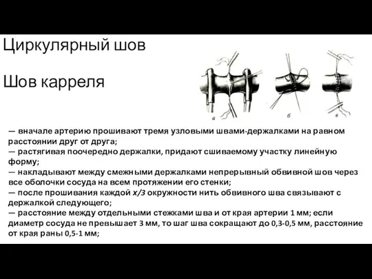 Циркулярный шов Шов карреля — вначале артерию прошивают тремя узловыми швами-держалками