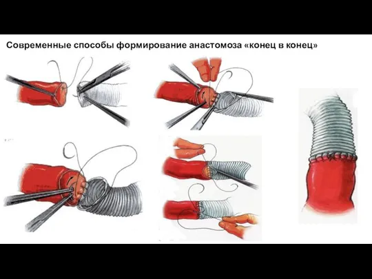 Современные способы формирование анастомоза «конец в конец»