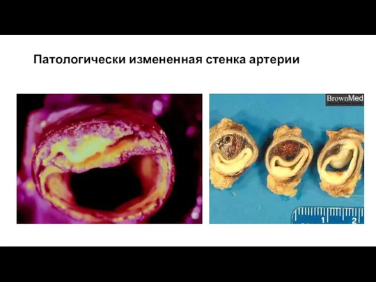 Патологически измененная стенка артерии