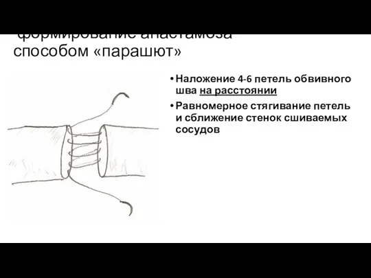 формирование анастамоза способом «парашют» Наложение 4-6 петель обвивного шва на расстоянии