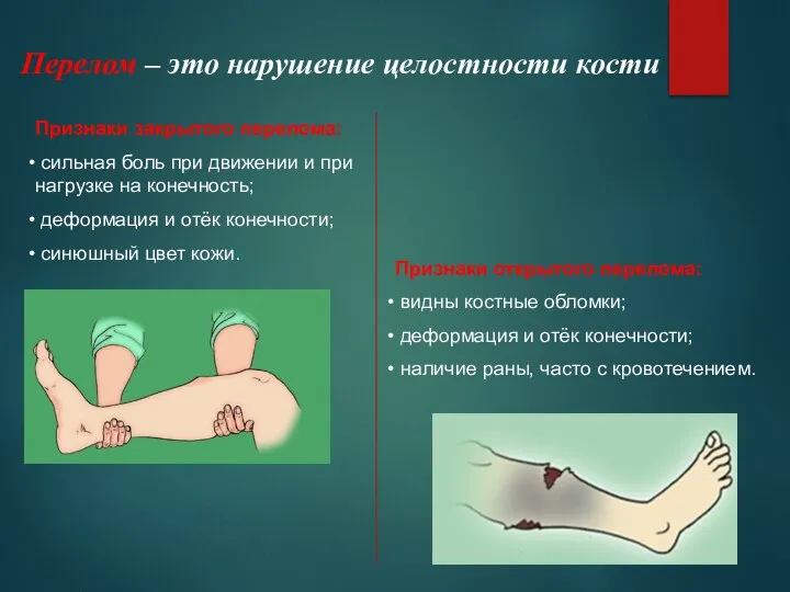 Перелом – это нарушение целостности кости Признаки закрытого перелома: сильная боль