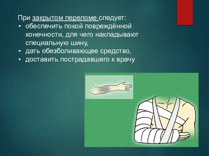 При закрытом переломе следует: обеспечить покой повреждённой конечности, для чего накладывают