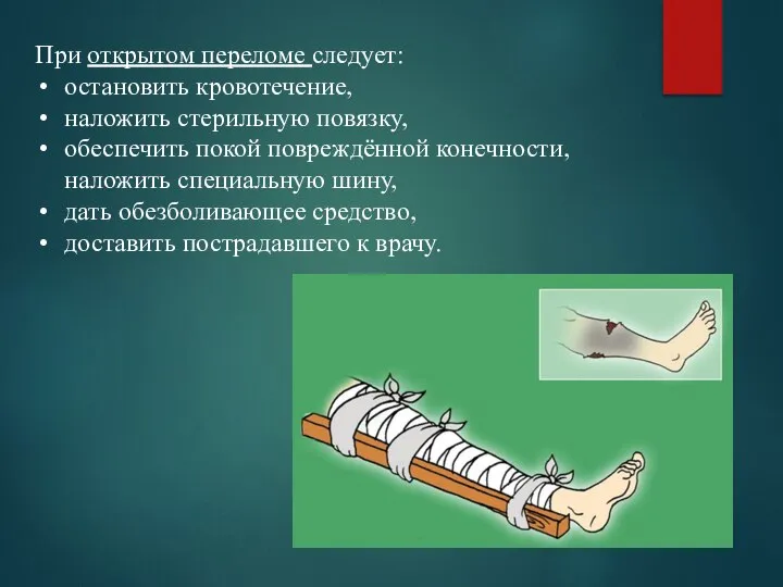 При открытом переломе следует: остановить кровотечение, наложить стерильную повязку, обеспечить покой