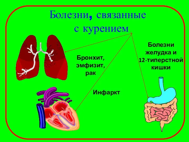 Болезни, связанные с курением Бронхит, эмфизит, рак Инфаркт Болезни желудка и 12-типерстной кишки