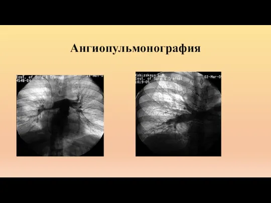 Ангиопульмонография