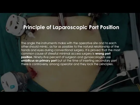 Principle of Laparoscopic Port Position The angle the instruments make with