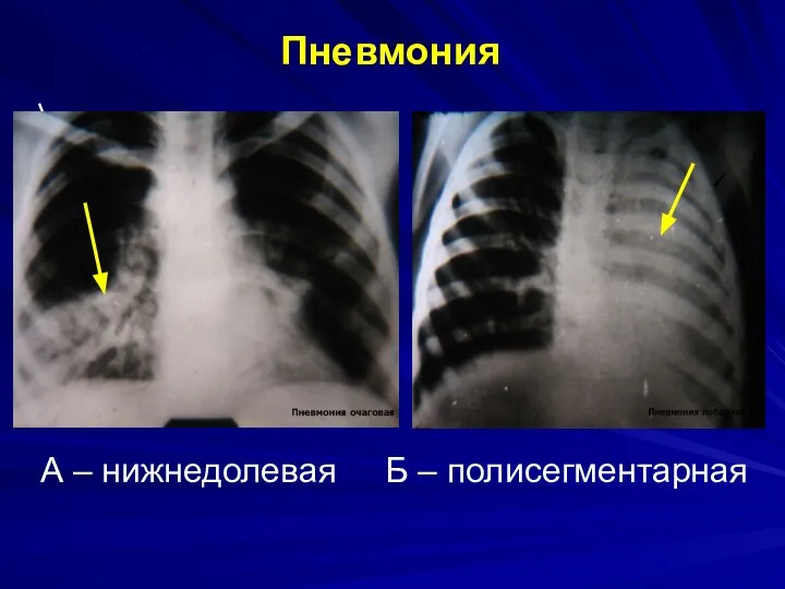 Пневмония А – нижнедолевая Б – полисегментарная