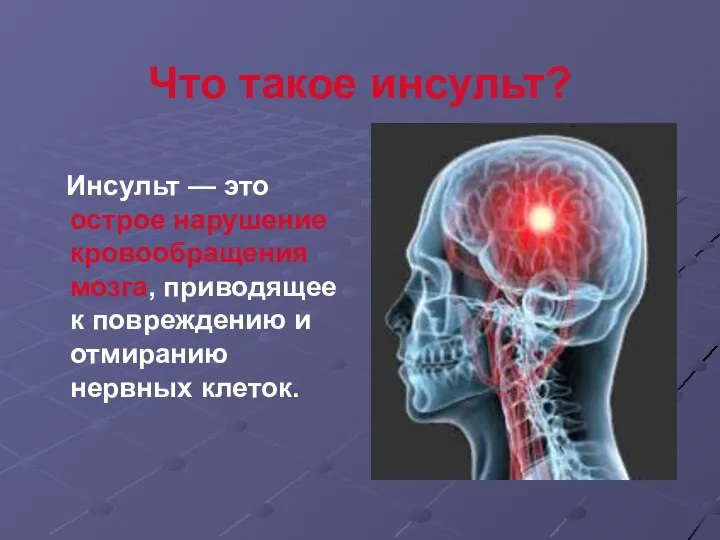 Что такое инсульт? Инсульт — это острое нарушение кровообращения мозга, приводящее