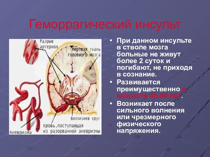 Геморрагический инсульт При данном инсульте в стволе мозга больные не живут