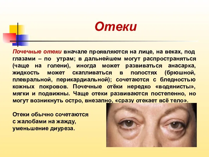 Отеки Почечные отеки вначале проявляются на лице, на веках, под глазами