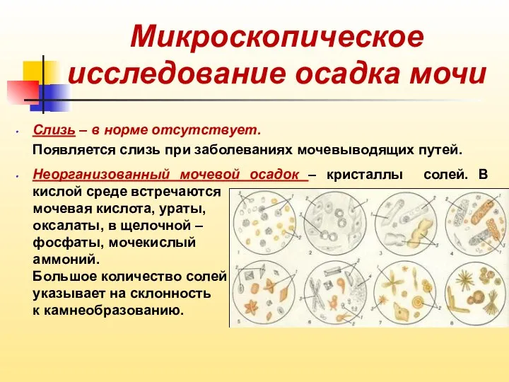 Микроскопическое исследование осадка мочи Слизь – в норме отсутствует. Появляется слизь