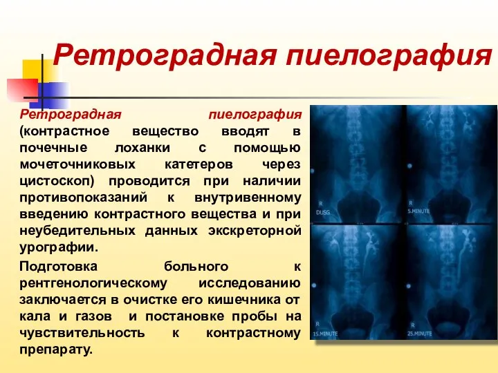 Ретроградная пиелография Ретроградная пиелография (контрастное вещество вводят в почечные лоханки с