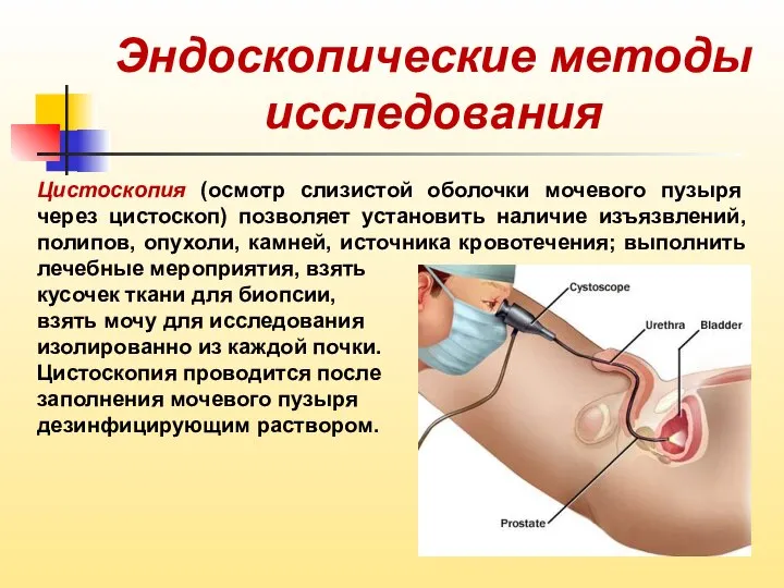 Эндоскопические методы исследования Цистоскопия (осмотр слизистой оболочки мочевого пузыря через цистоскоп)