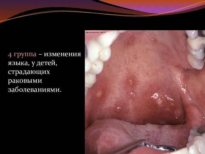 4 группа – изменения языка, у детей, страдающих раковыми заболеваниями.