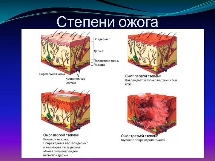 Степени ожога