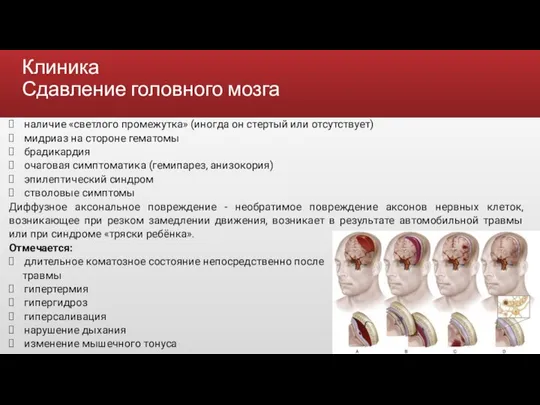 Клиника Сдавление головного мозга наличие «светлого промежутка» (иногда он стертый или