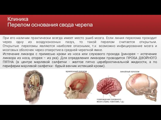 Клиника Перелом основания свода черепа При его наличии практически всегда имеет