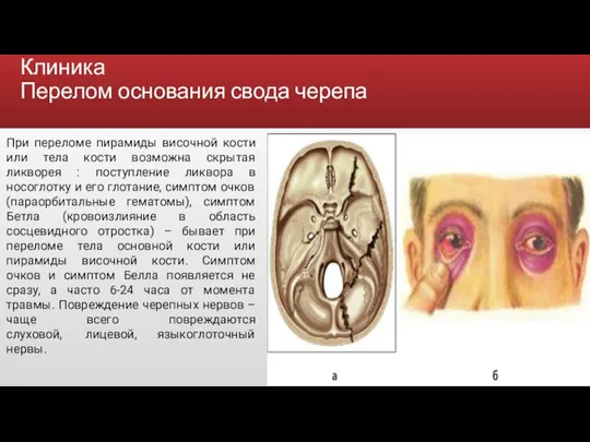 Клиника Перелом основания свода черепа При переломе пирамиды височной кости или