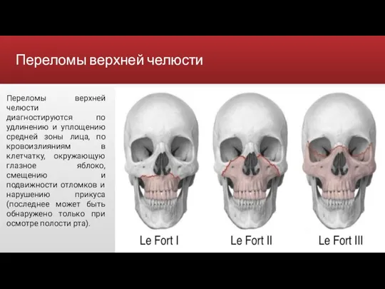 Переломы верхней челюсти Переломы верхней челюсти диагностируются по удлинению и уплощению