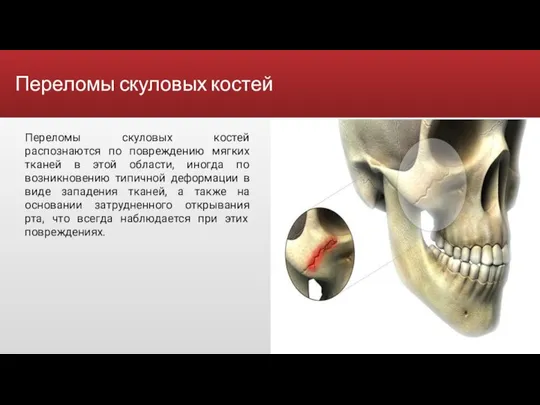 Переломы скуловых костей Переломы скуловых костей распознаются по повреждению мягких тканей