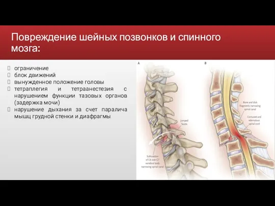 Повреждение шейных позвонков и спинного мозга: ограничение блок движений вынужденное положение