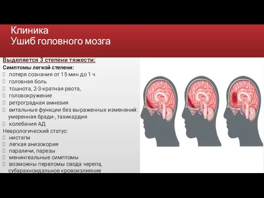 Клиника Ушиб головного мозга Выделяется 3 степени тяжести: Симптомы легкой степени: