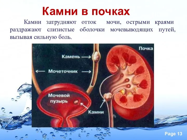 Камни в почках Камни затрудняют отток мочи, острыми краями раздражают слизистые