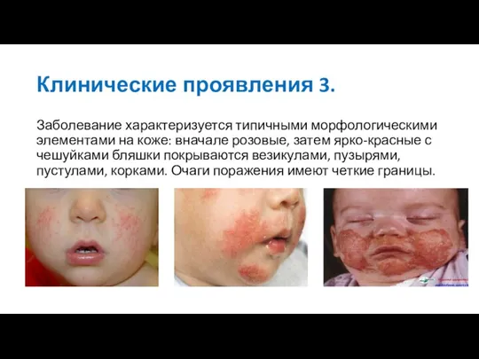 Клинические проявления 3. Заболевание характеризуется типичными морфологическими элементами на коже: вначале