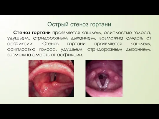 Острый стеноз гортани Стеноз гортани проявляется кашлем, осиплостью голоса, удушьем, стридорозным