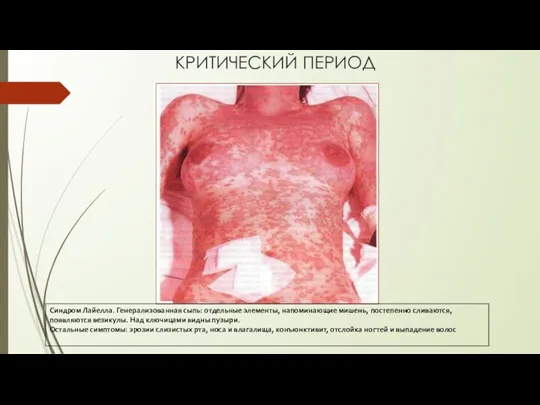 Синдром Лайелла. Генерализованная сыпь: отдельные элементы, напоминающие мишень, постепенно сливаются, появляются