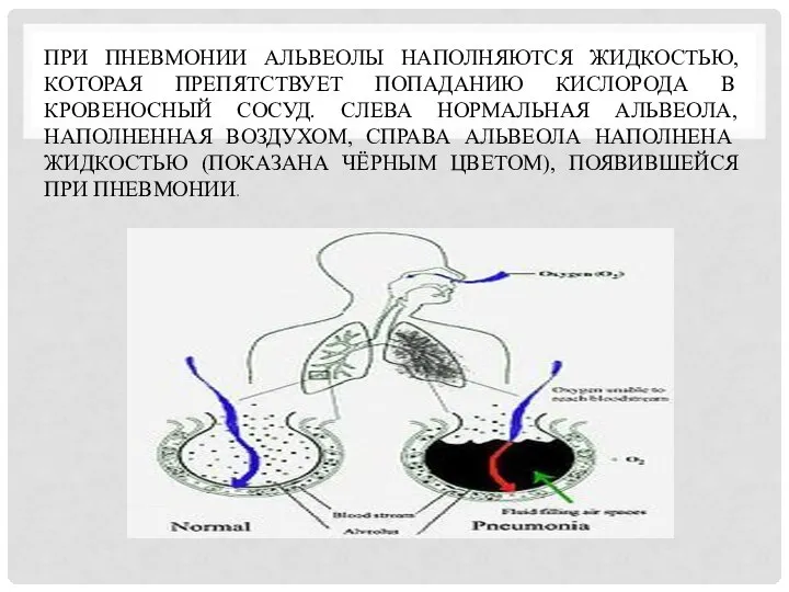 ПРИ ПНЕВМОНИИ АЛЬВЕОЛЫ НАПОЛНЯЮТСЯ ЖИДКОСТЬЮ, КОТОРАЯ ПРЕПЯТСТВУЕТ ПОПАДАНИЮ КИСЛОРОДА В КРОВЕНОСНЫЙ