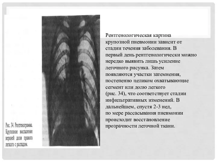 Рентгенологическая картина крупозной пневмонии зависит от стадии течения заболевания. В первый
